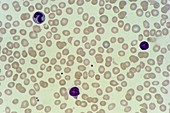 Blood film,acute lymphatic leukaemia