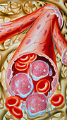 Illustration of chronic myeloid leukaemia