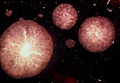 LM showing cell proliferation from mutant p53 gene
