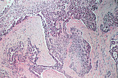 Light micrograph of mesothelioma lung tumour