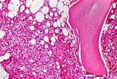 Light micrograph of secondary bone cancer