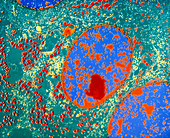 Coloured TEM of carcinoid (neuroendocrine) tumour