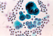 Light micrograph of mesothelioma lung tumour cells