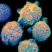 Colour SEM of lymphocytes in hairy cell leukaemia
