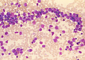 LM of blood cells in acute myelocytic leukaemia