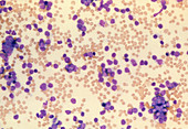 LM of acute lymphocytic leukaemia cells