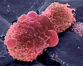 Lung cancer cell,SEM