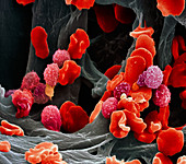 Leukaemia blood cells,SEM