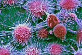 Kidney cancer cells,SEM
