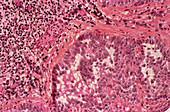 Mesothelioma cancer,light micrograph