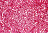 Spleen cancer,light micrograph