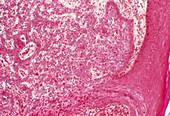 Skin cancer,light micrograph