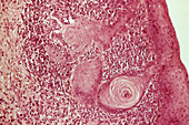 Laryngeal cancer,light micrograph