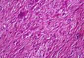 Muscle cell cancer,light micrograph