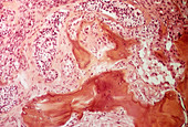 Secondary bone cancer,light micrograph