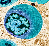 Thyroid cancer cell,TEM