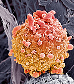 Skin cancer cell,SEM