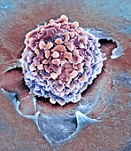 Rectal cancer cell,SEM
