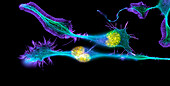 Nerve cancer cells,light micrograph
