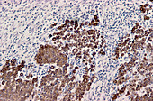 Lymph node cancer,light micrograph
