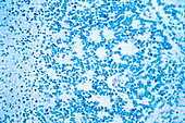 Neuroblastoma,light micrograph