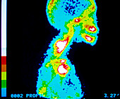 False-colour gamma scan of cancer in skull