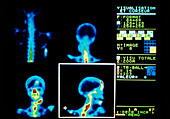 Gamma scan of skull & spine showing bone cancer