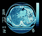 CT scan on chest showing lung cancer