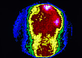 Immunoscintigram showing secondary cancer