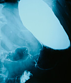 Barium meal X-ray of cancer