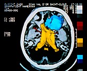 False-colour 3-D CT brain scan showing meningioma