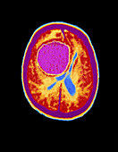 False-colour CT scan of large brain tumour