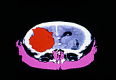 False-colour CT scan of glioblastoma brain tumour
