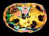 Coloured CT scan showing liver with metastases