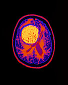 Coloured CT scan showing a large brain tumour