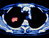 Coloured CT scan showing cancer of a lung