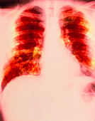 Coloured X-ray of secondary lung cancer