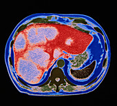 CT of liver cancer