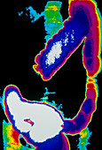 Coloured X-ray showing cancer of the colon