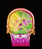 Coloured MRI scan of a metastatic brain tumour
