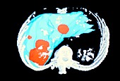 Coloured 3-D CT scan of metastatic liver cancer