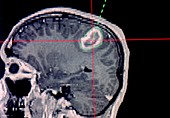 MRI scan of brain tumour showing route for surgery