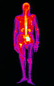 Coloured Gamma scan of metastatic thyroid cancer