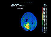 Coloured PET scan of brain containing a tumour