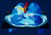 Coloured computed tomography scan of lung cancer