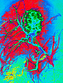 Coloured angiogram X-ray of a tumour in the liver