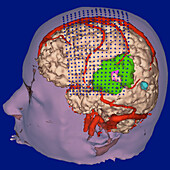 3-D MRI scan of a brain with tumour