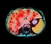 Liver cancer CT scan