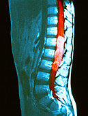 Spinal cord cancer MRI
