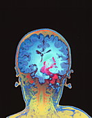 Brain cancer MRI